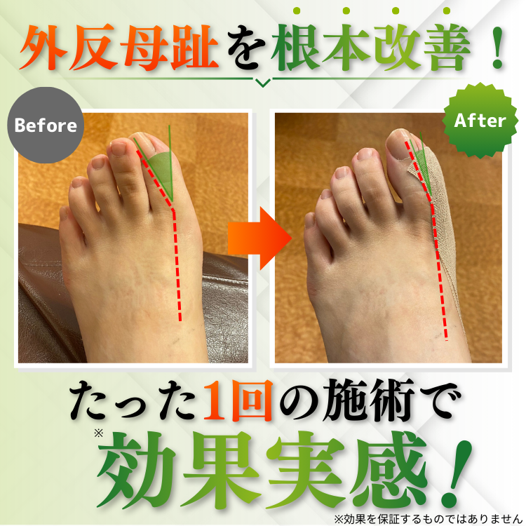 外反母趾ビフォーアフター
